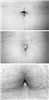 Umbilicus (belly button) hooding in women.